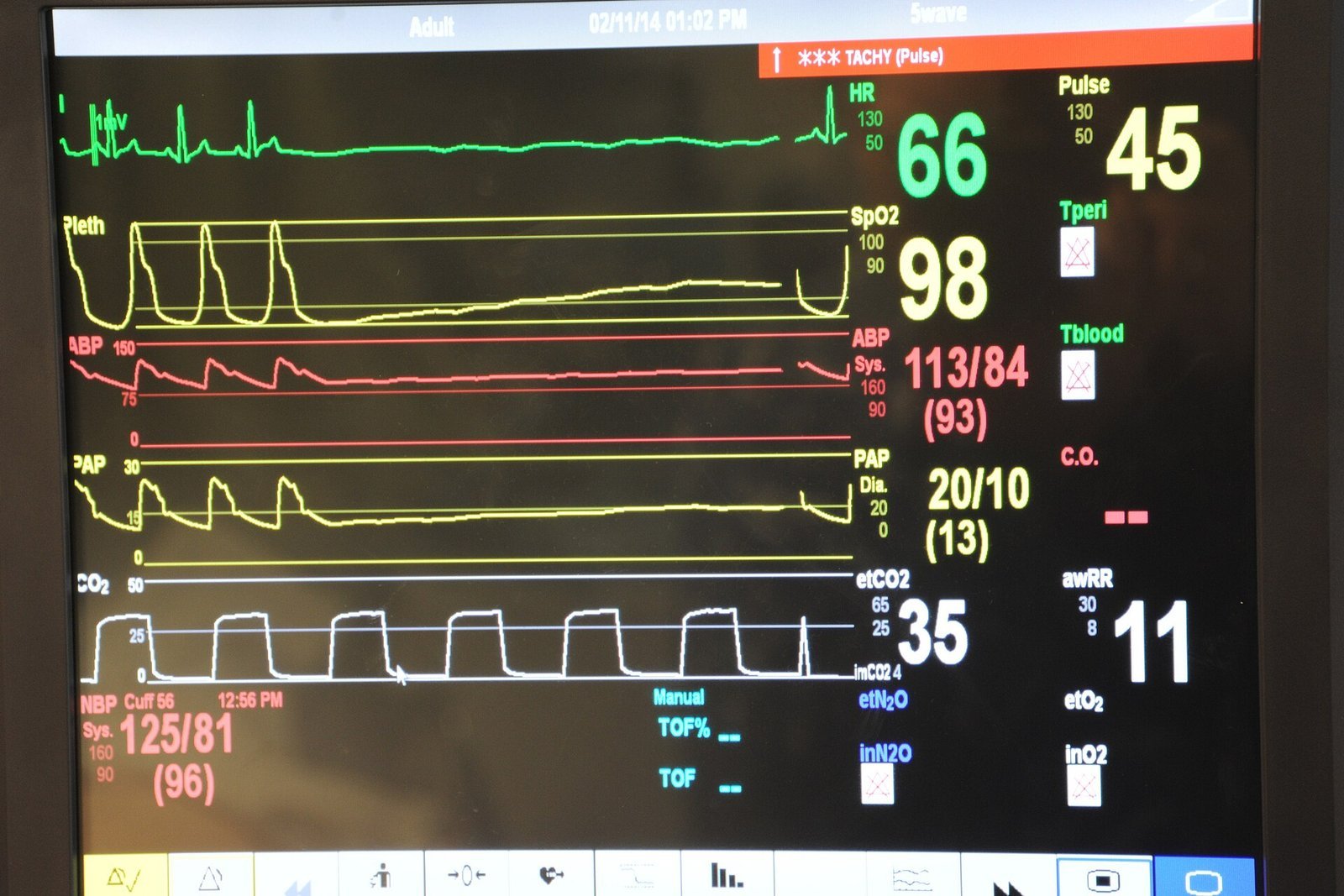 Un monitor de signos vitales que muestra formas de onda fisiológicas como el ECG, que ilustra el análisis de señales biomédicas.